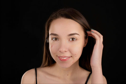 A woman with acne on her cheeks and chin smiles.